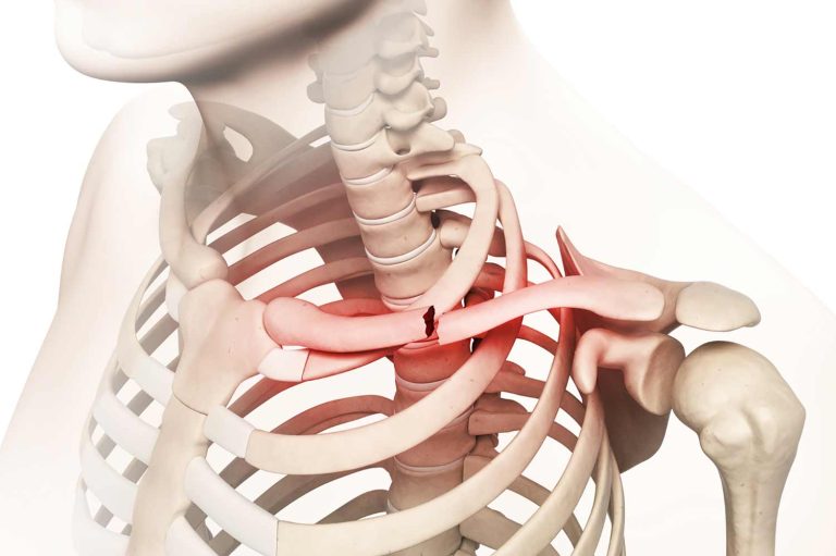 fracture de la clavicule